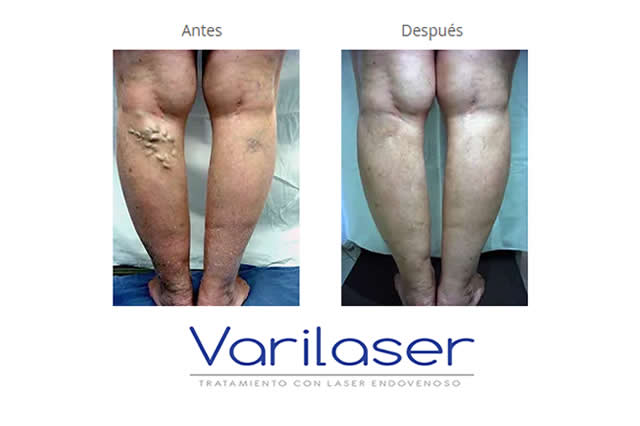 TESTIMONIOS VARICES - HIPERHIDROSIS
