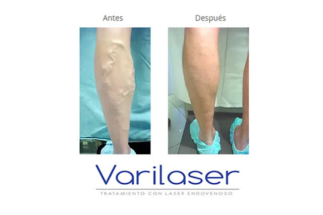 VARICES QUITO
