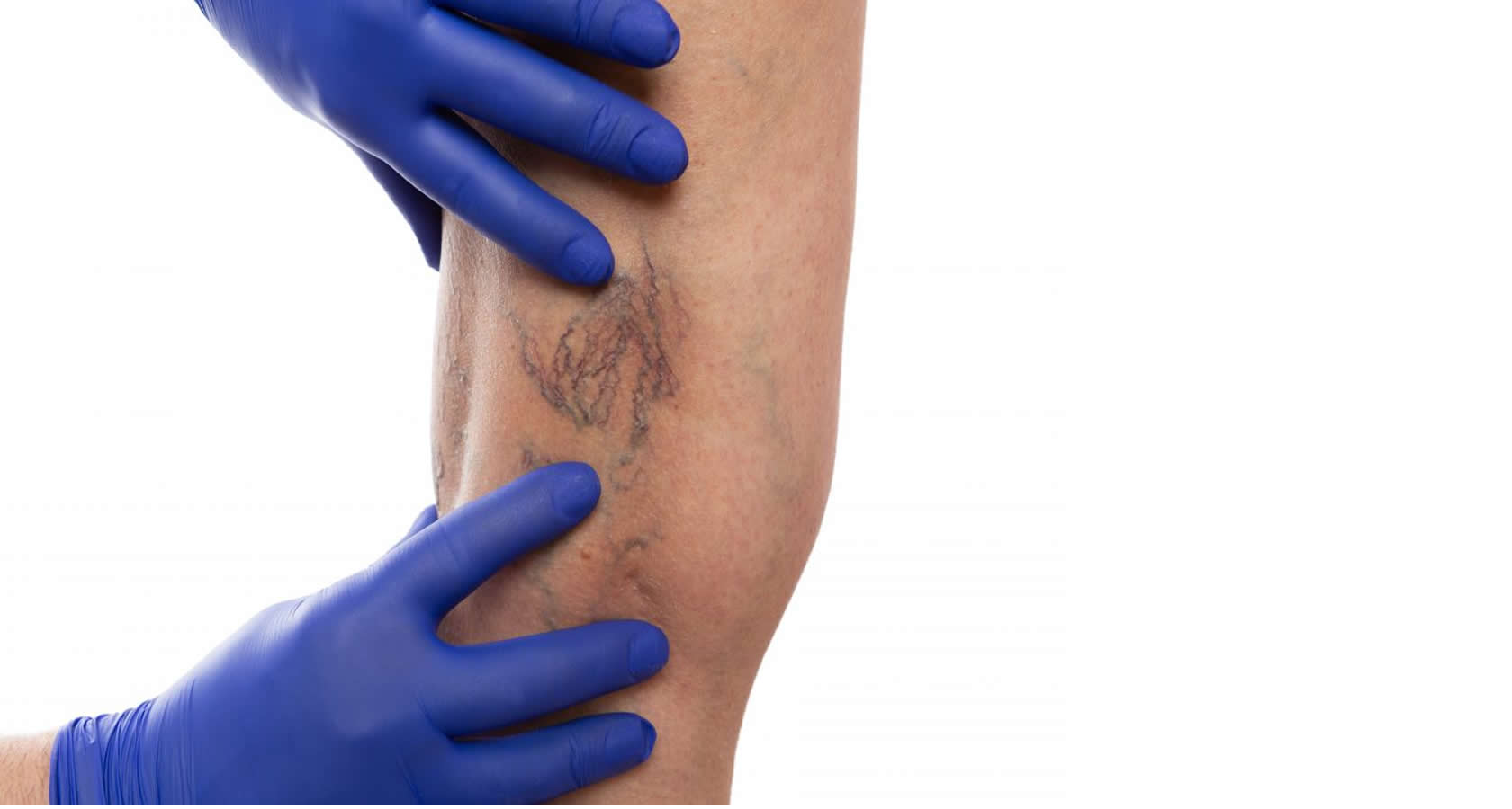 CIRUGIA LASER VARICES